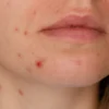 Close-up of acne spots on a woman's chin and cheek