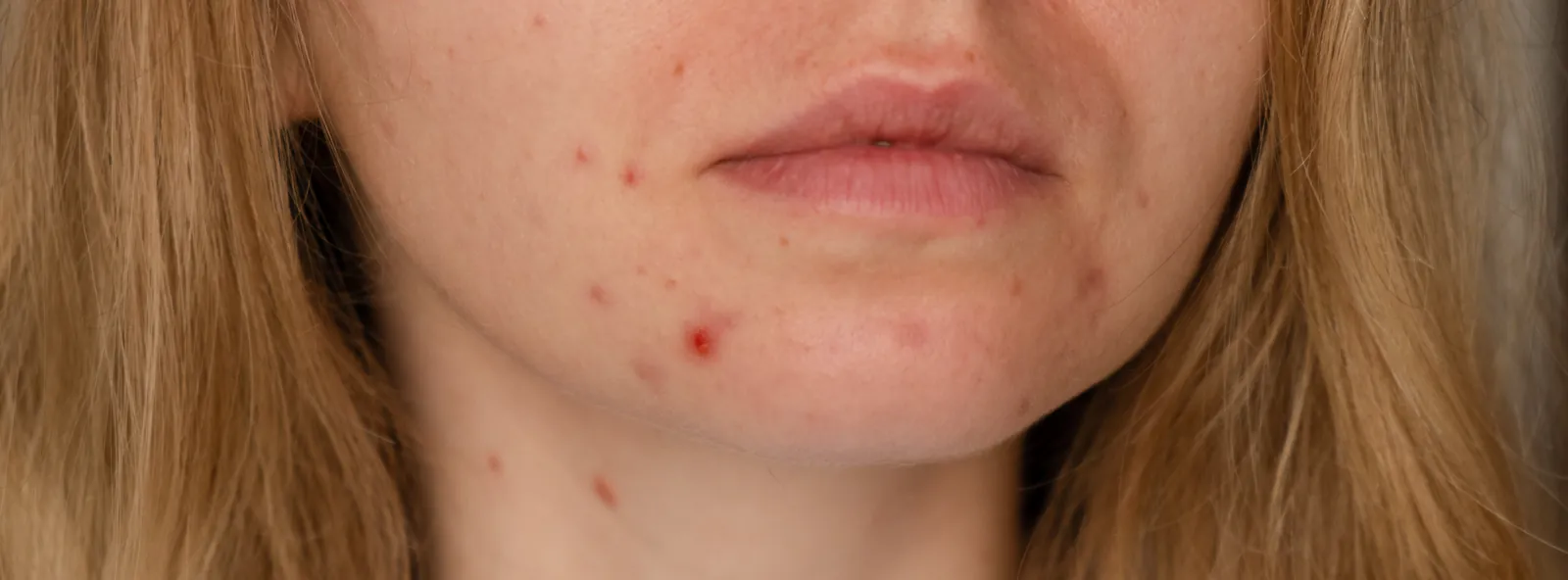 Close-up of acne spots on a woman's chin and cheek
